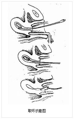 ҽԺʹȡ 